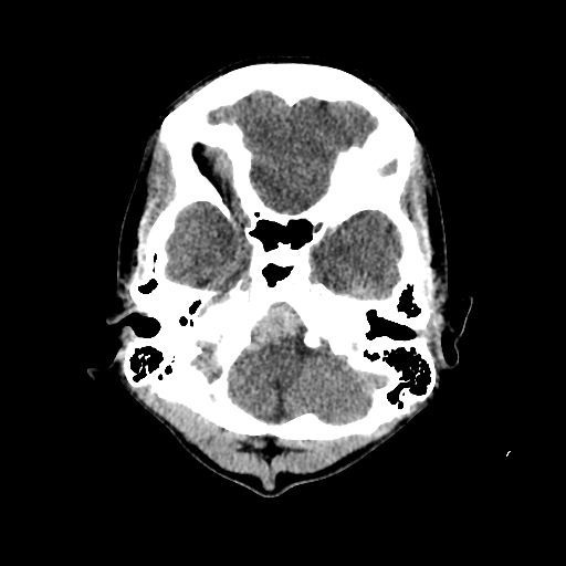 File:Basilar artery perforator aneurysm (Radiopaedia 82455-96597 Axial non-contrast 5).jpg