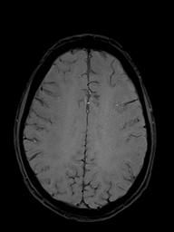 Basilar artery perforator aneurysm (Radiopaedia 82455-97733 Axial SWI 41).jpg