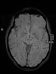 Basilar artery perforator aneurysm (Radiopaedia 82455-99523 Axial SWI 30).jpg
