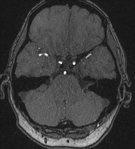 Basilar tip aneurysm (Radiopaedia 26504-26632 MRA 61).jpg