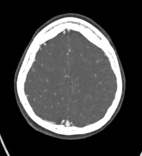 File:Basilar tip aneurysm with coiling (Radiopaedia 53912-60086 A 118).jpg