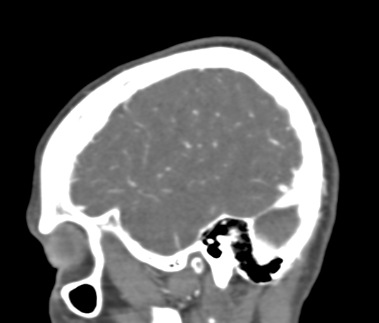 Basilar tip aneurysm with coiling (Radiopaedia 53912-60086 C 20).jpg