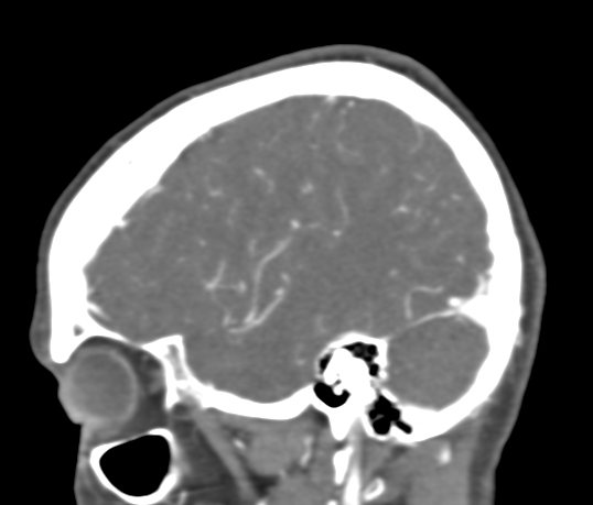 Basilar tip aneurysm with coiling (Radiopaedia 53912-60086 C 25).jpg