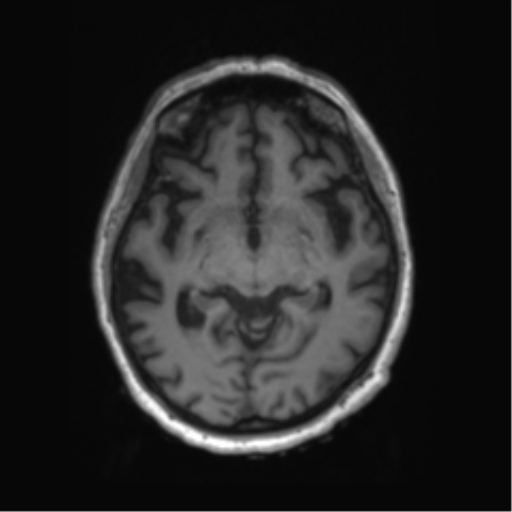 Behavioral variant frontotemporal dementia and late onset schizophrenia (Radiopaedia 52197-58083 Axial T1 59).png
