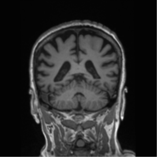 Behavioral variant frontotemporal dementia and late onset schizophrenia (Radiopaedia 52197-58083 Coronal T1 36).png