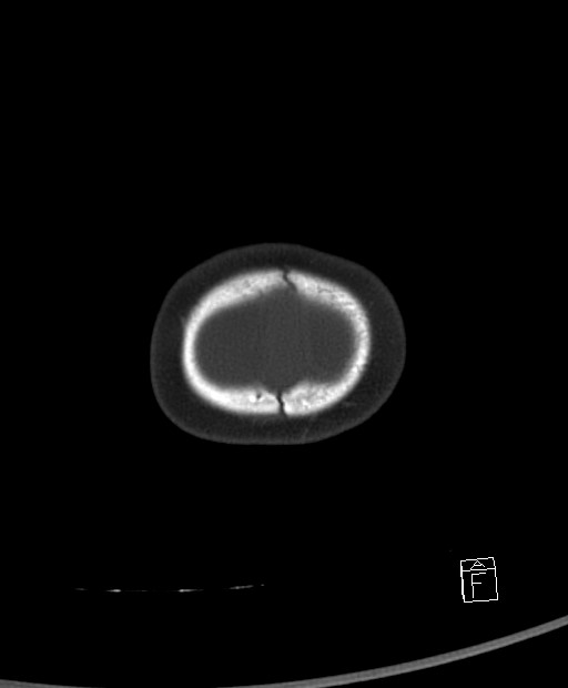 Benign enlargement of subarachnoid spaces in infancy (BESS) (Radiopaedia 87459-103795 Axial bone window 2).jpg
