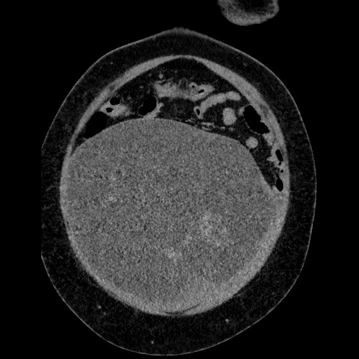 File:Benign leiomyoma with hydropic features (Radiopaedia 89250-106130 B 30).jpg