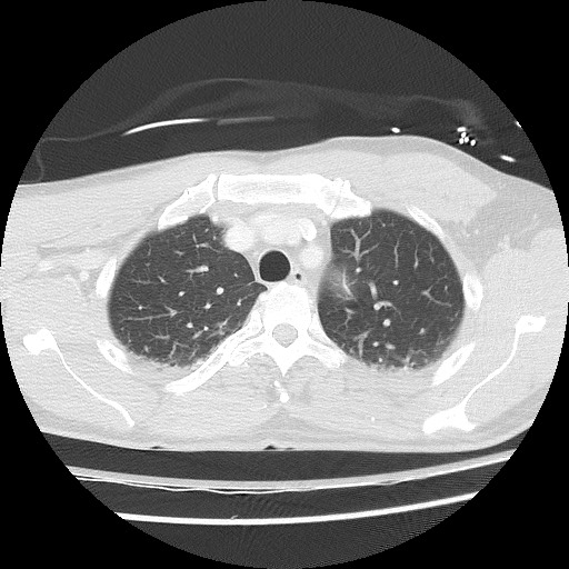 Benign post-traumatic pseudopneumoperitoneum (Radiopaedia 71199-81495 Axial lung window 23).jpg