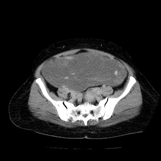 Benign spindle cell tumor - abdominopelvic (Radiopaedia 61300-69212 Axial C+ delayed 48).jpg