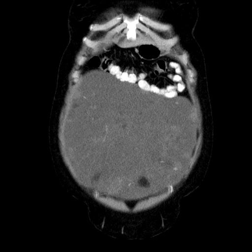 File:Benign spindle cell tumor - abdominopelvic (Radiopaedia 61300-69212 C 13).jpg