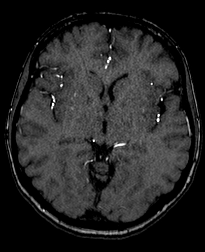 Berry aneurysm of the terminal internal carotid artery (Radiopaedia 88286-104918 Axial TOF 122).jpg