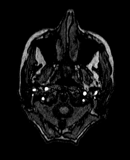 Berry aneurysm of the terminal internal carotid artery (Radiopaedia 88286-104918 Axial TOF 23).jpg