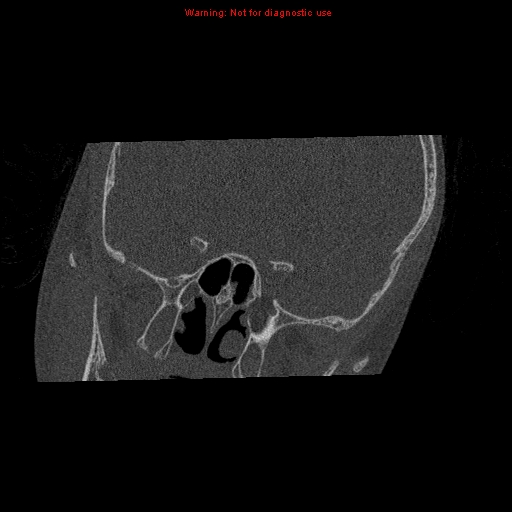 Bezold abscess (Radiopaedia 21645-21605 bone window 1).jpg