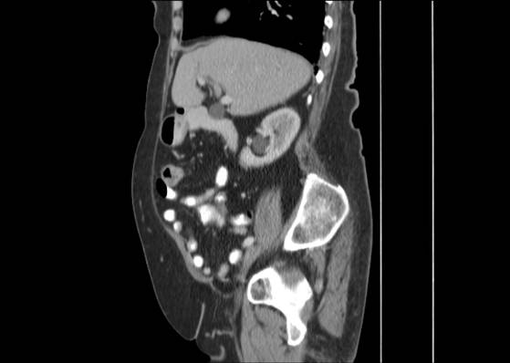 File:Bicameral celiacomesenteric aneurysm (Radiopaedia 55766-62327 B 21).jpg