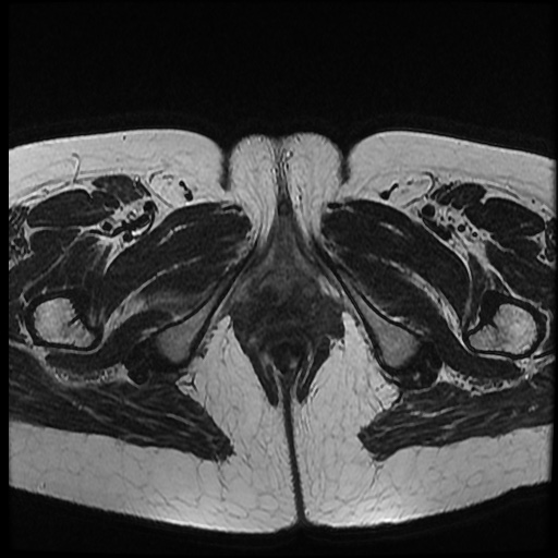 File:Bicornuate uterus (Radiopaedia 51676-57472 Axial T2 4).jpg