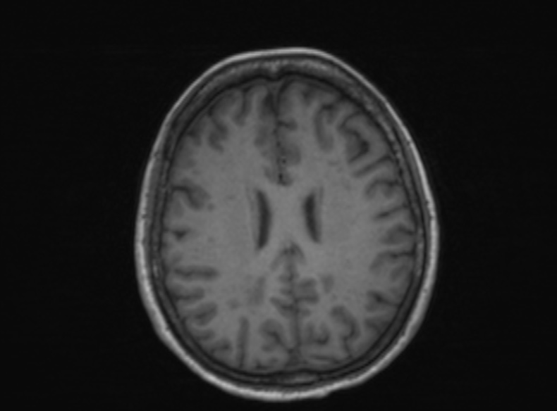 Bilateral PCA territory infarction - different ages (Radiopaedia 46200-51784 Axial T1 198).jpg