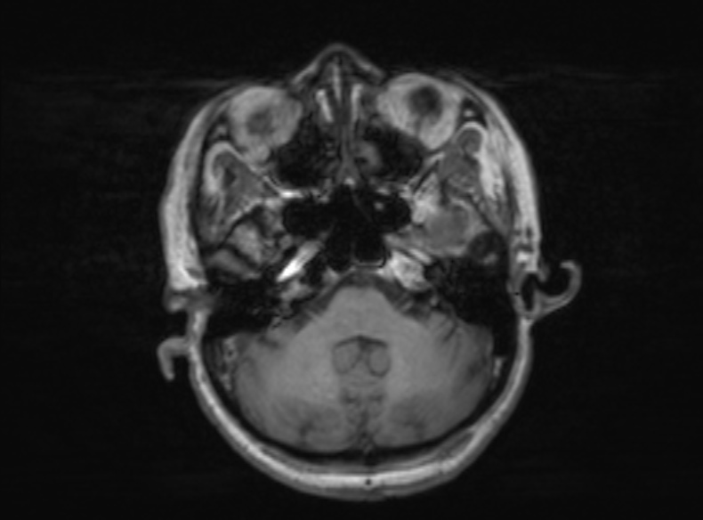 Bilateral PCA territory infarction - different ages (Radiopaedia 46200-51784 Axial T1 309).jpg