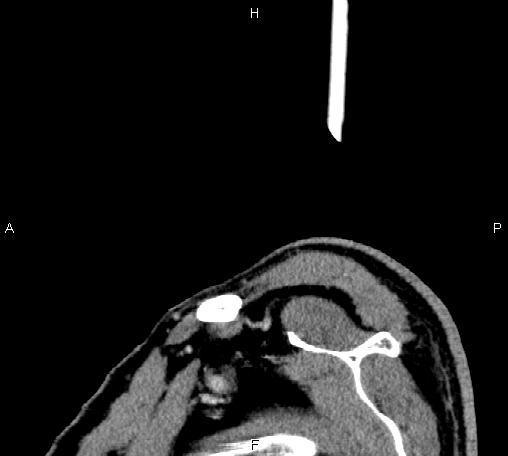 Bilateral Warthin tumors (Radiopaedia 84034-99263 D 5).jpg