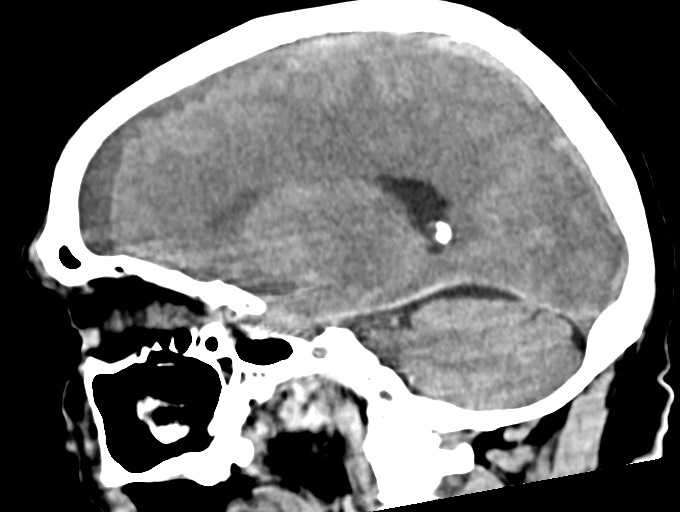 Bilateral acute on chronic subdural hematomas (Radiopaedia 78466-91146 C 25).jpg