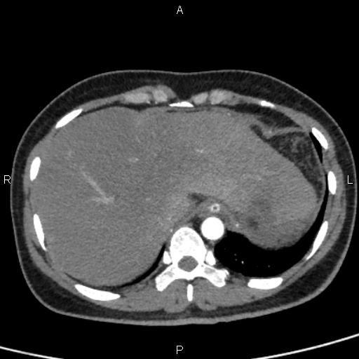 Bilateral adrenal gland hyperenhancement in pancreatitis (Radiopaedia 86642-102753 B 16).jpg