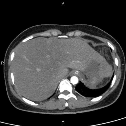 File:Bilateral adrenal gland hyperenhancement in pancreatitis (Radiopaedia 86642-102753 B 17).jpg