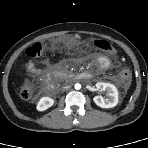 Bilateral adrenal gland hyperenhancement in pancreatitis (Radiopaedia 86642-102753 B 65).jpg