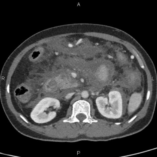 File:Bilateral adrenal gland hyperenhancement in pancreatitis (Radiopaedia 86642-102753 E 44).jpg