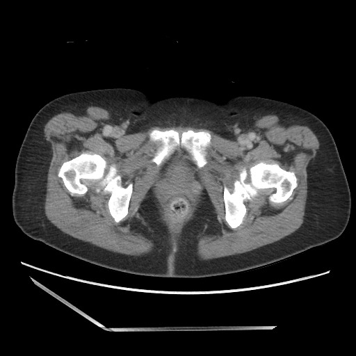 Bilateral adrenal granulocytic sarcomas (chloromas) (Radiopaedia 78375-91007 A 120).jpg