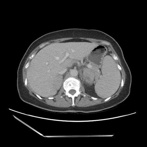 Bilateral adrenal granulocytic sarcomas (chloromas) (Radiopaedia 78375-91007 A 34).jpg