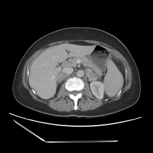 Bilateral adrenal granulocytic sarcomas (chloromas) (Radiopaedia 78375-91007 A 45).jpg