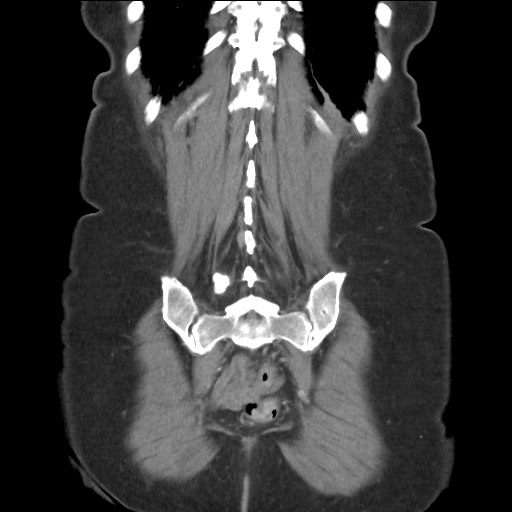 Bilateral adrenal granulocytic sarcomas (chloromas) (Radiopaedia 78375-91007 B 78).jpg
