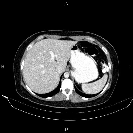 File:Bilateral adrenal myelolipoma (Radiopaedia 63058-71535 B 32).jpg