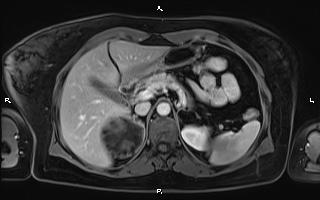 Bilateral adrenal myelolipoma (Radiopaedia 63058-71537 G 33).jpg