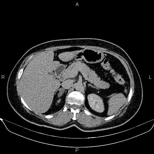 File:Bilateral benign adrenal adenomas (Radiopaedia 86912-103124 Axial C+ delayed 35).jpg