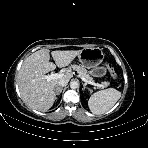 Bilateral benign adrenal adenomas (Radiopaedia 86912-103124 B 30).jpg