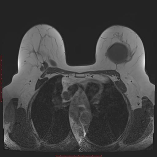 File:Bilateral breast implant rupture (Radiopaedia 24761-25027 T1 14).jpg