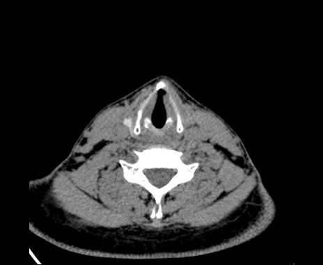 Bilateral carotid body tumors (Radiopaedia 61841-69870 Axial non-contrast 76).jpg