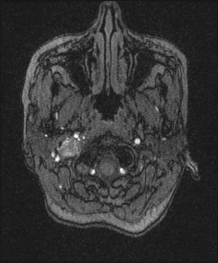 Bilateral carotid body tumors and right glomus jugulare tumor (Radiopaedia 20024-20060 Axial MRA 8).jpg