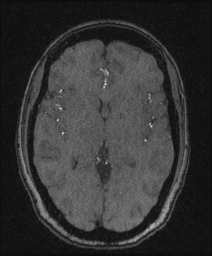 Bilateral carotid body tumors and right glomus jugulare tumor (Radiopaedia 20024-20060 Axial MRA 95).jpg