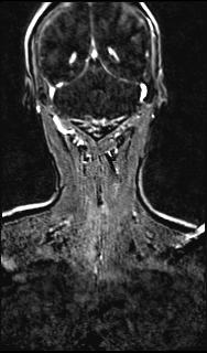 File:Bilateral carotid body tumors and right glomus jugulare tumor (Radiopaedia 20024-20060 MRA 134).jpg