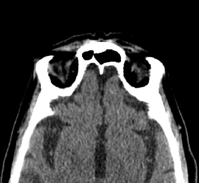 Bilateral ectopia lentis (Radiopaedia 89889-107013 Axial non-contrast 11).jpg