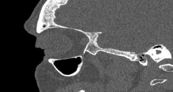 File:Bilateral ectopic infraorbital nerves (Radiopaedia 49006-54084 Sagittal 35).png