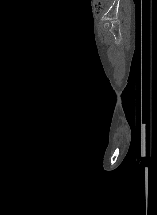 Bilateral fibular hemimelia type II (Radiopaedia 69581-79491 Sagittal bone window 60).jpg