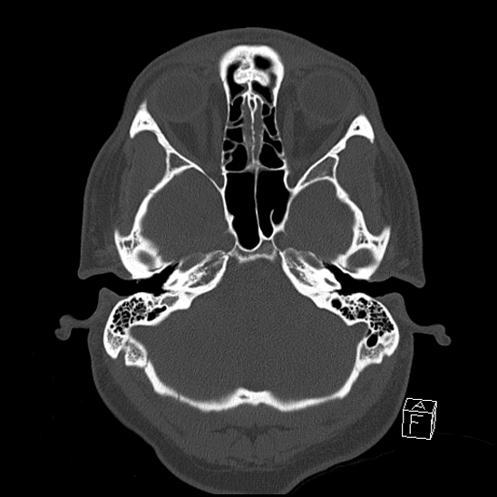 Bilateral occipital condyle fracture (type 2) (Radiopaedia 87675-104089 Axial bone window 27).jpg