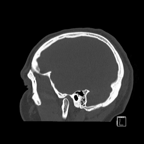 Bilateral occipital condyle fracture (type 2) (Radiopaedia 87675-104089 Sagittal bone window 9).jpg
