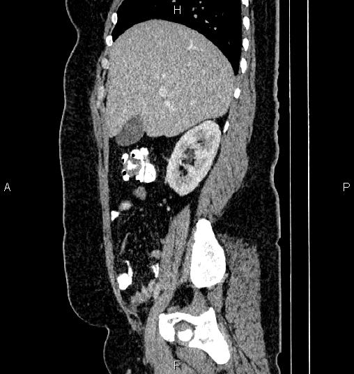 Bilateral ovarian dermoid cysts (Radiopaedia 85785-101603 D 24).jpg