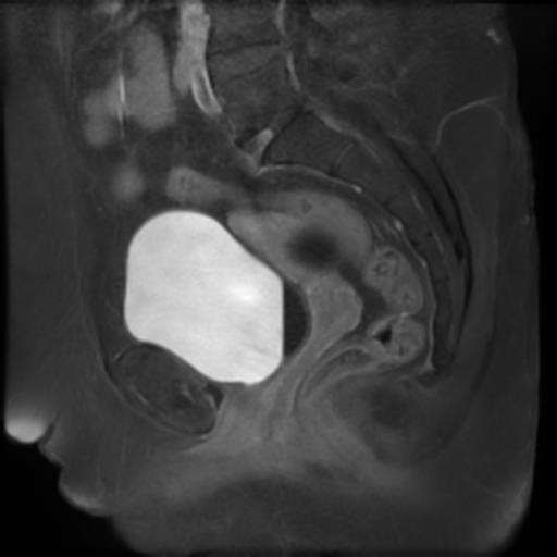 File:Bilateral ovarian dermoid cysts (Radiopaedia 90152-107338 Sagittal T1 C+ 12).jpg