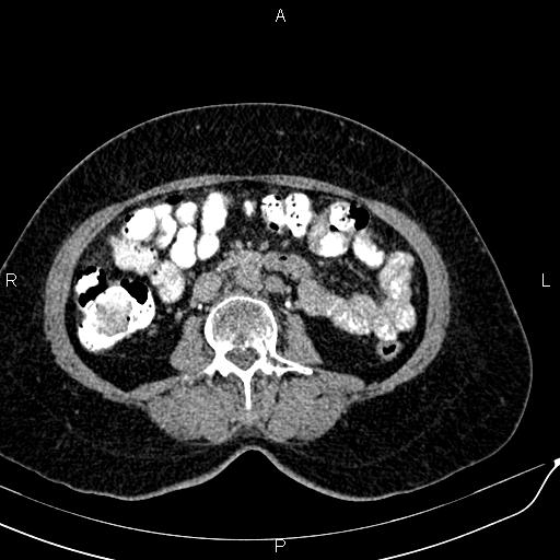File:Bilateral ovarian serous cystadenocarcinoma (Radiopaedia 86062-101989 Axial C+ delayed 34).jpg