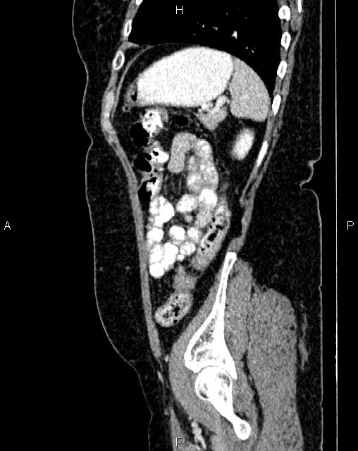 Bilateral ovarian serous cystadenocarcinoma (Radiopaedia 86062-101989 E 71).jpg