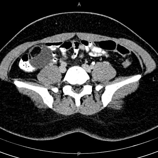 File:Bilateral ovarian teratoma (Radiopaedia 83131-97503 B 10).jpg